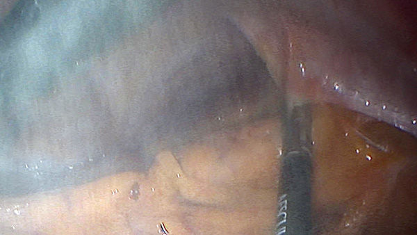 EinsteinVision® in laparoscopic surgery with smoke reduction